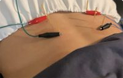 epc-Dry-Needling-Therapy